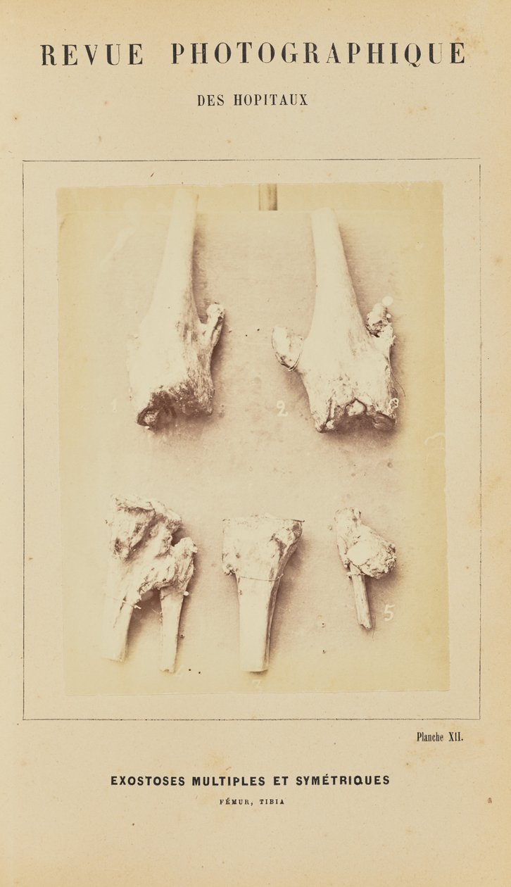 Meerdere symmetrische exostosen, femur, tibia door Arthur de Montmeja