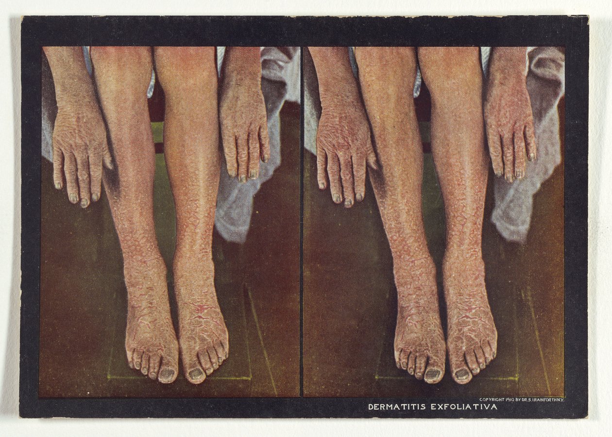 Dermatitis Exfoliativa door Dr. Selden I. Rainforth