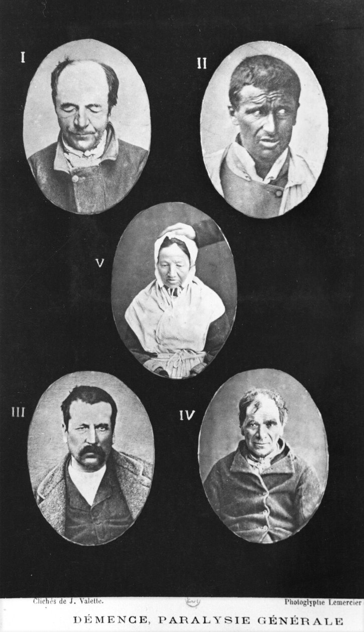 Dementie, Algemene Verlamming, illustratie uit Nouveau traité élémentaire et pratique des maladies mentales door Henri Dagonet (1823-1902) Parijs, Baillière, 1876 door French Photographer