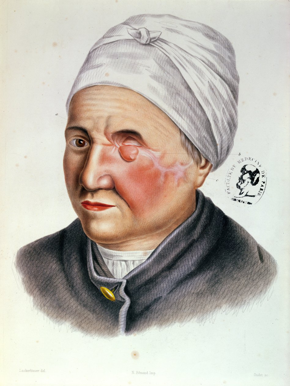 Illustratie uit Traite de Chirurgie Plastique door Antoine Jobert de Lamballe, Parijs, 1849 door Lackerbauer