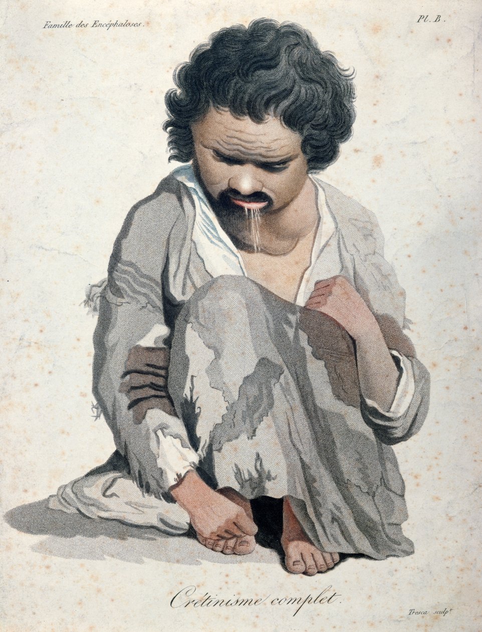 Totale cretinisme, uit een boek van Baron Jean Louis Alibert (1768-1837) door Salvadore Tresca