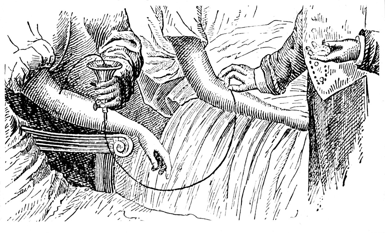 Bloedtransfusie, ca. 1880 door Unbekannt