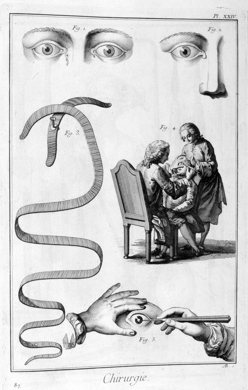 Oogchirurgie, 1751-1777 door Unbekannt