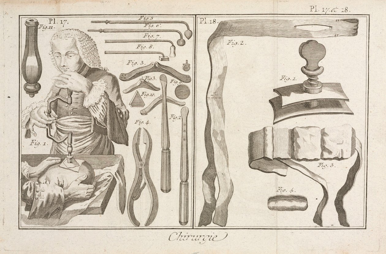 Trepanatie door Unbekannt