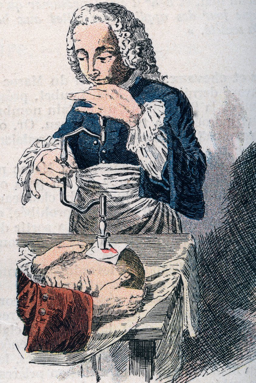 De trepanatie. Prent uit de 18e eeuw. door Unknown artist