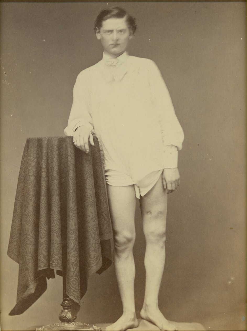 Gewonde Soldaat uit de Burgeroorlog (Private Charles Westerfield, Army Medical Museum Specimen No. 4278), april 1865, 1865 door William Abraham Bell