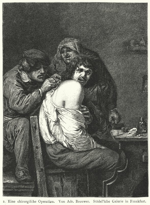 De Rugoperatie door Adriaen (after) Brouwer